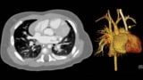 Cardiac photon-counting CT