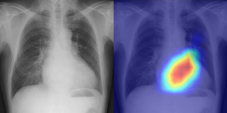 Diagnosing heart disease from a chest X-ray