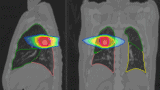 Lung scans