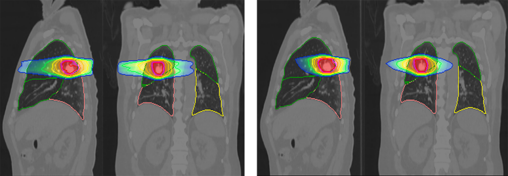 Image data offer functional clues for lung radiotherapy – Physics World