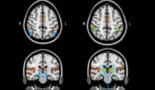 Regions of the brain activated during an auditory task