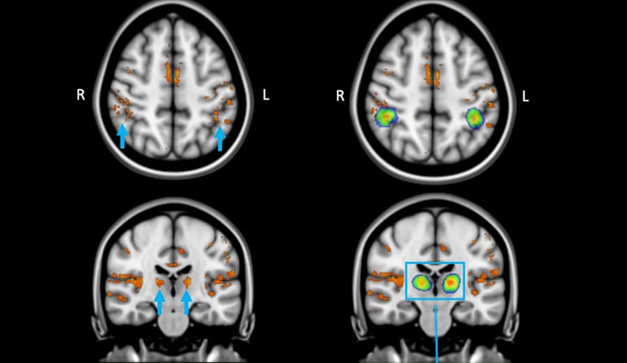 Ultrahigh-field MRI reveals how blue light stimulates the brain – Physics World