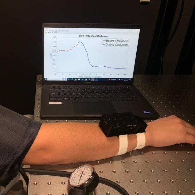 Photo of a new wearable imaging device that monitors changes in blood flow in a patientâ€™s hands, feet or arms. The device is strapped to a person's wrist and the person is looking at a graph on a laptop screen