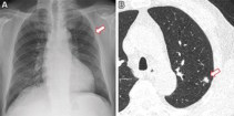 Risk prediction from chest X-ray