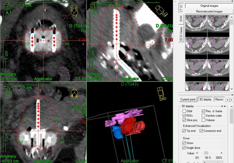 Radcalc monte carlo and 3d collapsed cone subscription physics world