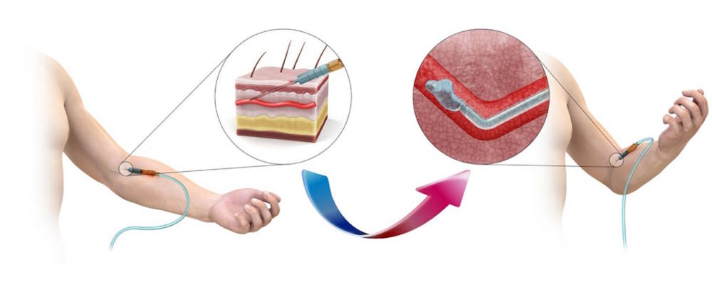 Smart intravenous needle softens upon insertion into a blood vessel ...