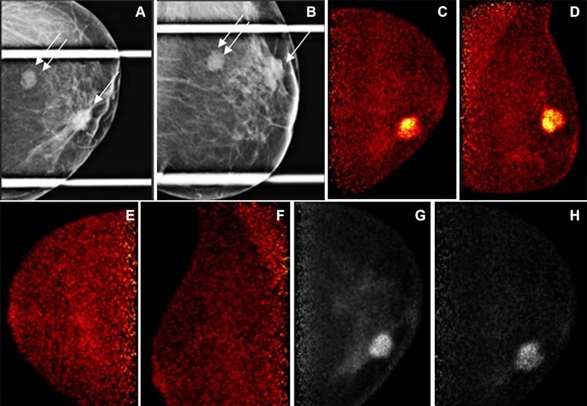 Molecular imaging technique could improve breast cancer screening