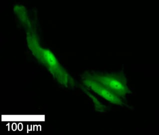 Fluorescence images of brain cancer cells