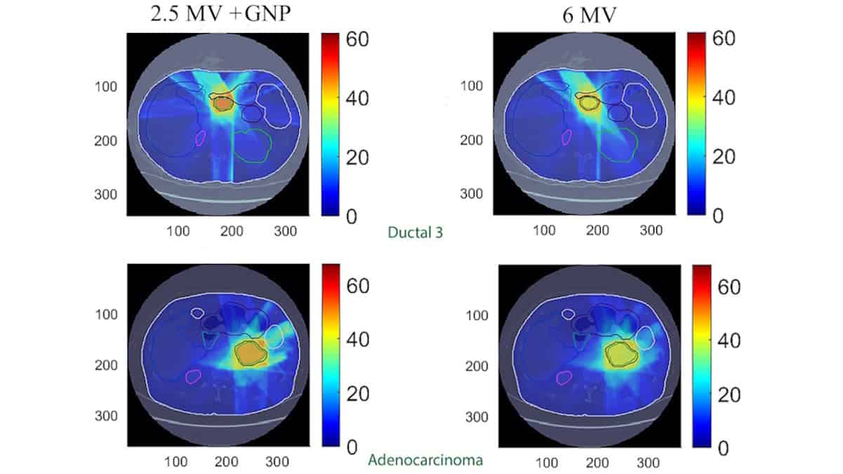 Gold nanoparticles could improve radiotherapy of pancreatic cancer – Physics World