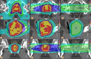 Dosimetric comparisons of prostate cancer treatment plans