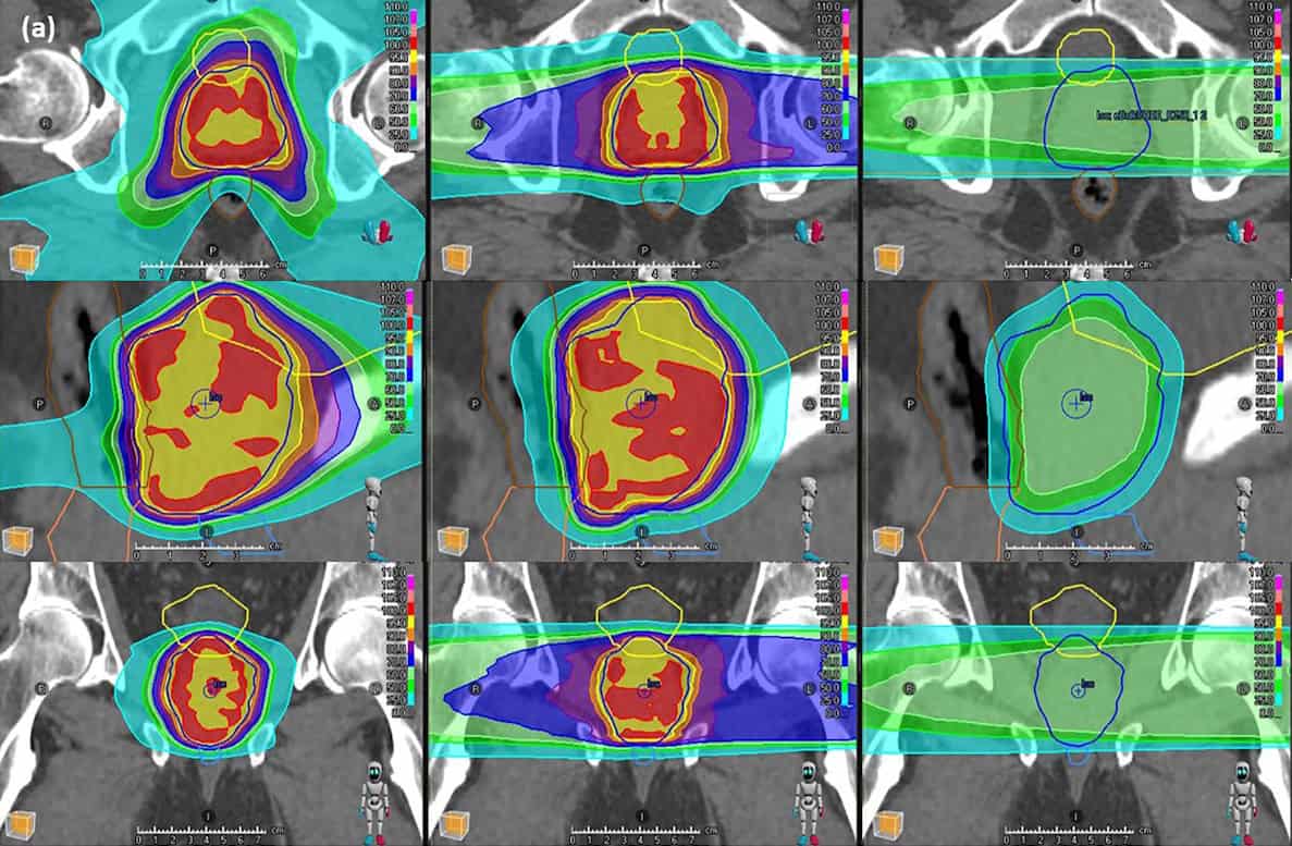 Hybrid irradiation could facilitate clinical translation of FLASH radiotherapy – Physics World