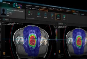 RayStation treatment planning system