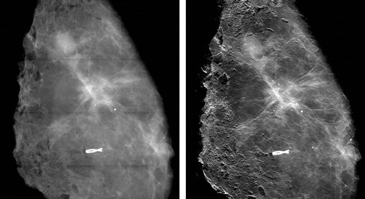 Mammogram images