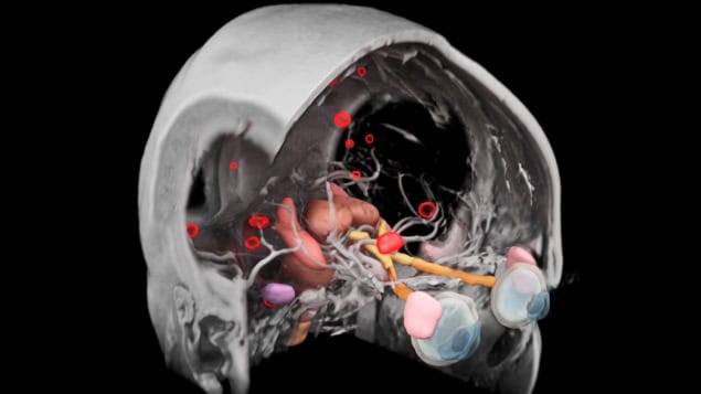 AI-based contouring of multiple brain metastases