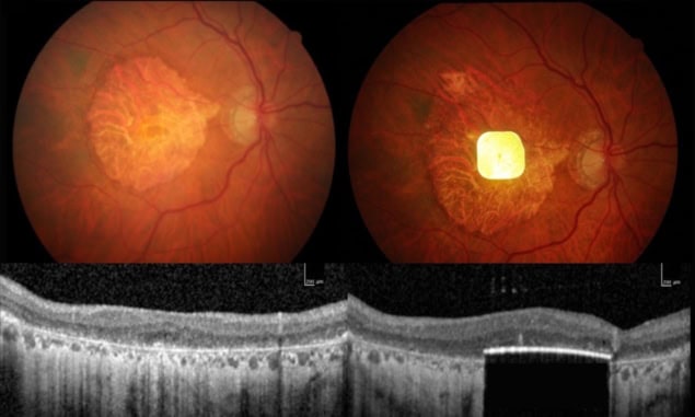 Eye images before and after array implantation
