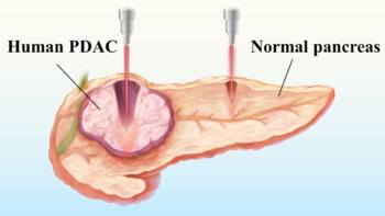 Selective ablation of pancreatic cancer