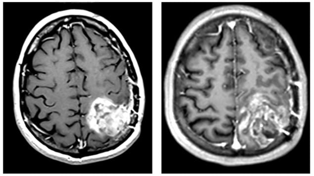 Brain MR images before and after TheraBionic treatment Brain MR images before and after TheraBionic treatment