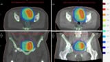 Reference and adapted treatment plans