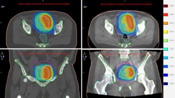 Reference and adapted treatment plans