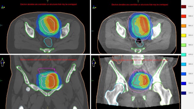 Reference and adapted treatment plans Reference and adapted treatment plans