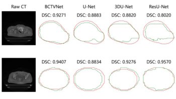 CT scan slices and target contours