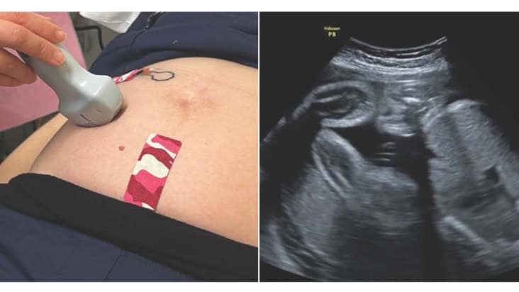 Pressure and strain sensors on a clinical trial volunteer