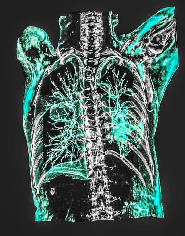 A 3D chest CT scan
