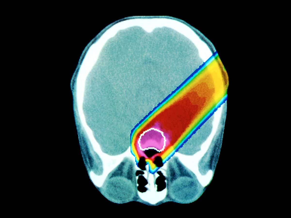 Proton therapy cancer treatment