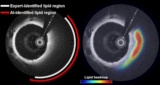 AI-based OCT detection of lipid-rich plaque