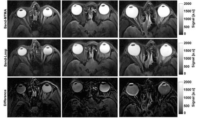 Metamaterial antennas enhance MR images of the eye and brain – Physics ...