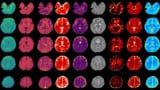 Multiple biomarkers in a whole-brain MRx scan