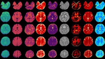 Multiple biomarkers in a whole-brain MRx scan