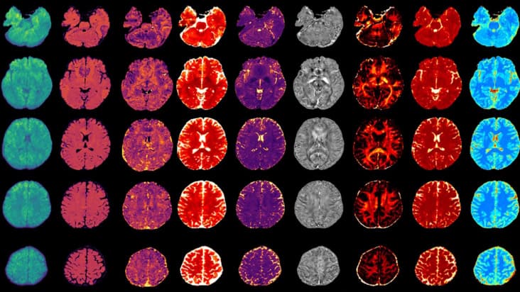 Multiple biomarkers in a whole-brain MRx scan