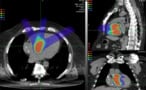 Example proton cardiac radioablation treatment plan