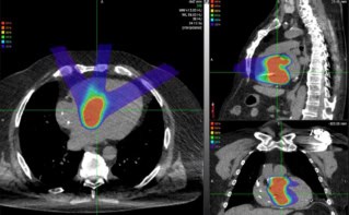 Example proton cardiac radioablation treatment plan