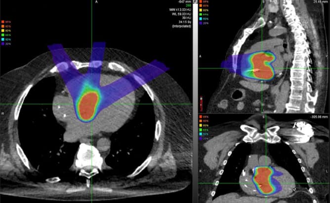 Example proton cardiac radioablation treatment plan
