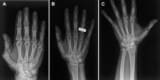 Hand radiographs recorded in space and on Earth