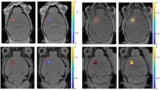 Brain tumour MR images