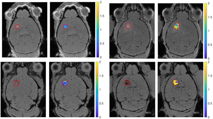 Brain tumour MR images